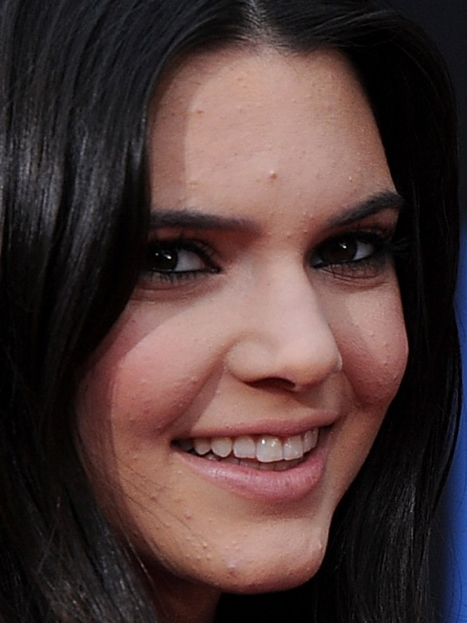 Exclusive Kendall Jenner’s Secret For Flawless Skin “when I Was Growing Up I Had Really Bad
